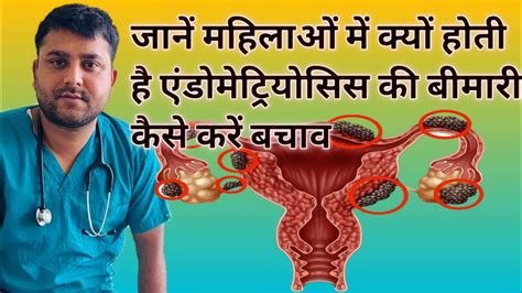 endometriosis meaning in hindi